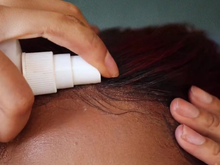 Attaching a hair system at the hairline